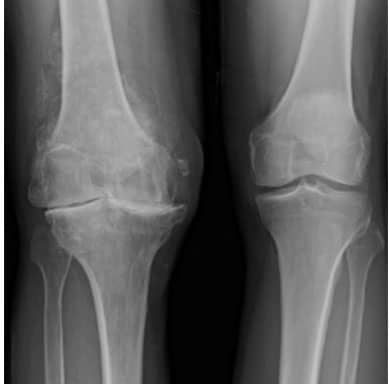Knee Joints