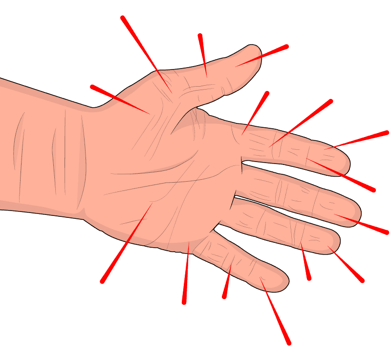 Human hand during stage 1 of Hand Arm Vibration Syndrome