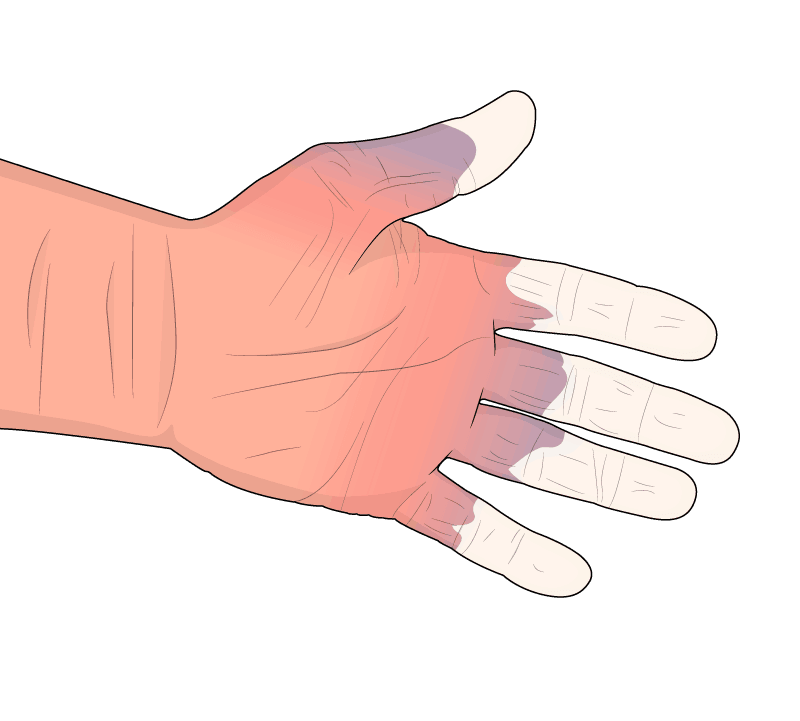 Human hand during stage 2 of Hand Arm Vibration Syndrome