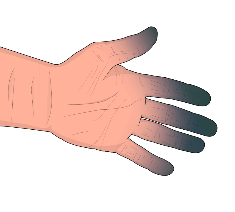 Human hand during stage 3 of Hand Arm Vibration Syndrome