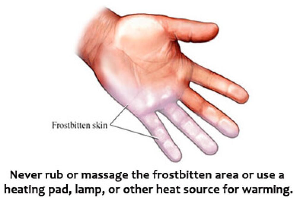 Frostbitten skin, never rub or massage the frostbitten area.