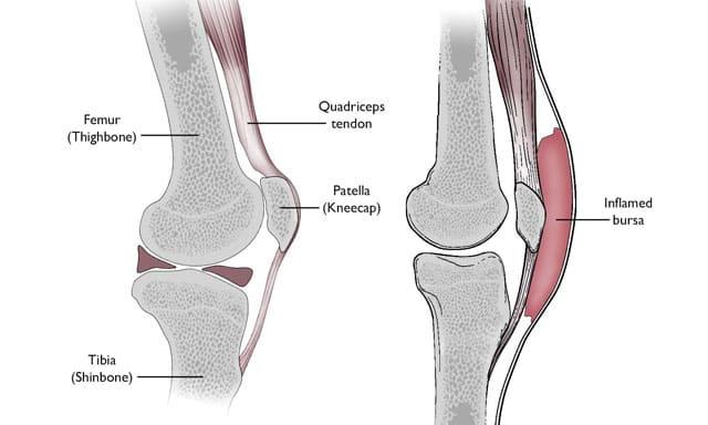 Inflamed bursa, otherwise known as prepatellar bursitis