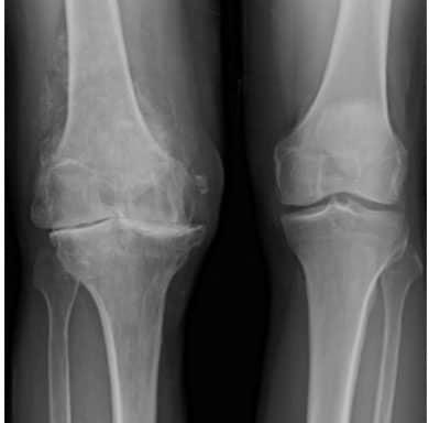 Osteoarthritis in the left knee